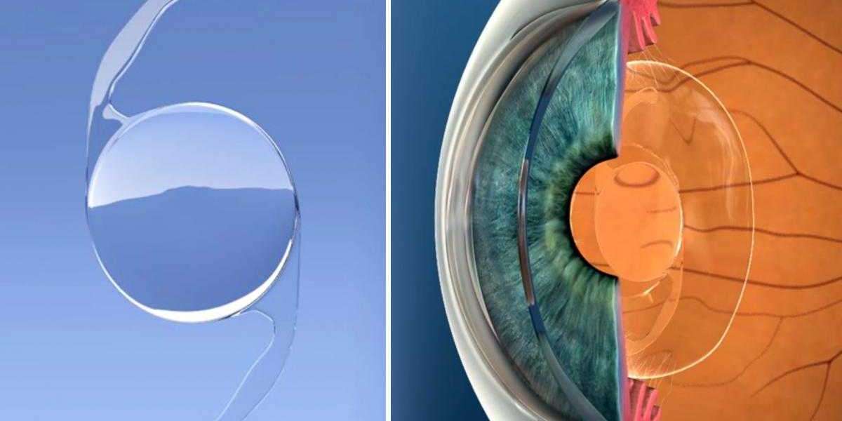 Precision Procedure: Navigating Cataract Surgery for Enhanced Eye Health