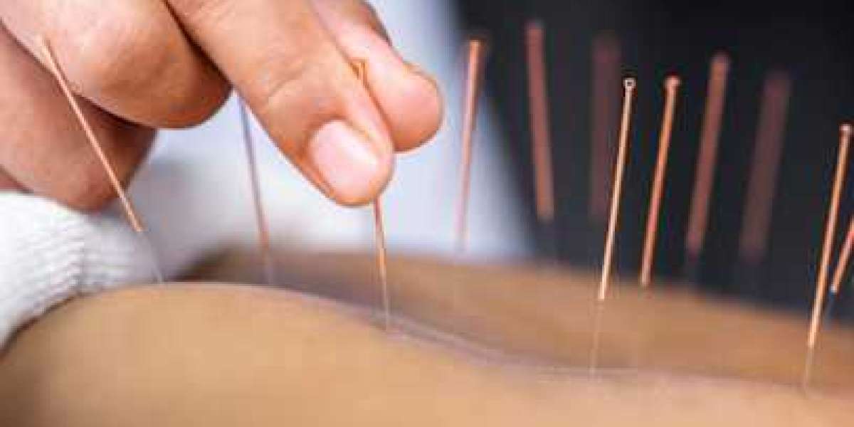 Discovering Wellness: Best Acupuncture in Downtown Edmonton, AB