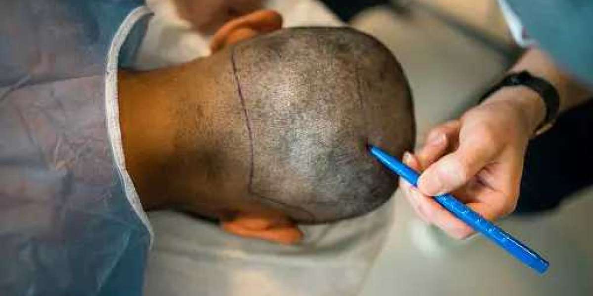 Unlocking Confidence: Afro-Caribbean Hair Transplant in the UK