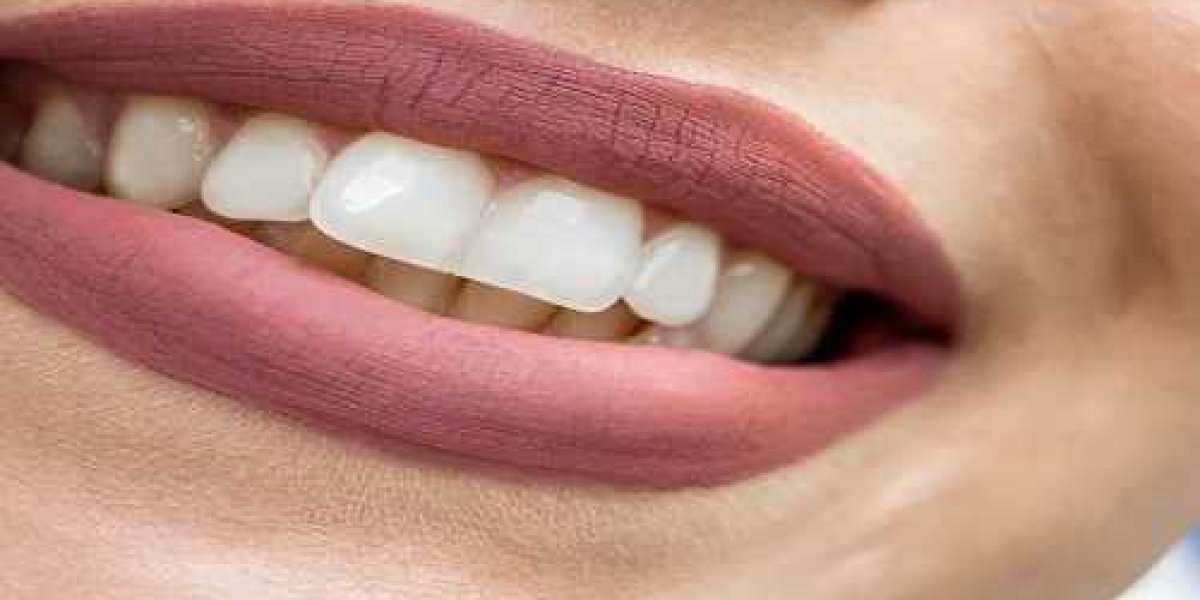 Is Teeth Whitening Prior to Composite Bonding Recommended?