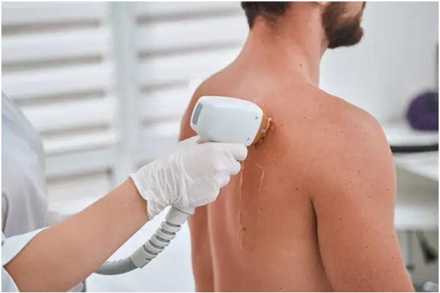Laser Back Hair Removal for Men A Guide to Permanent Solutions | by AZ Laser Studio | May, 2024 | Medium